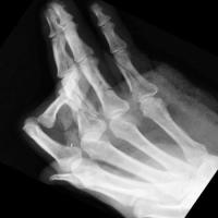bone-fracture project thumbnail