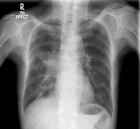 TB-classification project thumbnail