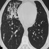 lung project thumbnail
