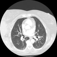 Lung nodule project thumbnail