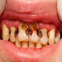 tooth caries test 21 project thumbnail