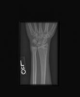 fracture detection project thumbnail
