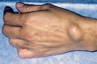 Ganglion Cyst project thumbnail