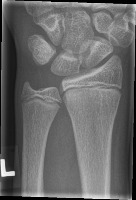 Wrist Fracture Dataset project thumbnail