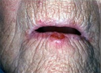 Oral Cancer1 project thumbnail