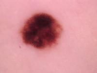 skin-cancer project thumbnail