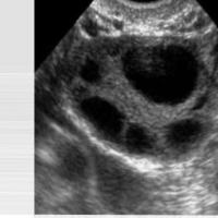AI Powered Follicle Detection project thumbnail