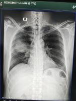Pneumonia project thumbnail