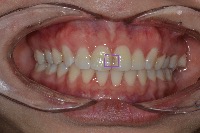 dental lesion project thumbnail