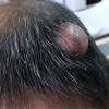 Scalp Infection project thumbnail