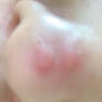acne_detection project thumbnail