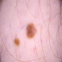 Cancer Detection project thumbnail