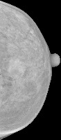 mammography detection project thumbnail