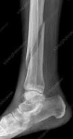 Bone fracture project thumbnail