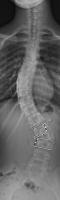 spine test seg single class project thumbnail