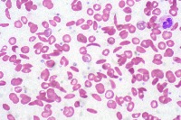 Sickle-Shaped Blood Cells project thumbnail