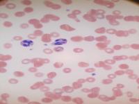 Malaria Infected & Uninfected project thumbnail