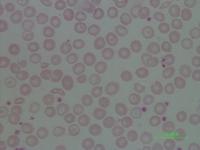 Malaria Positif & Negatif project thumbnail