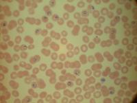 Plasmodium Falciparum project thumbnail