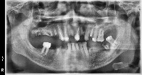 tooth (tooth-c0qco) - Roboflow Universe