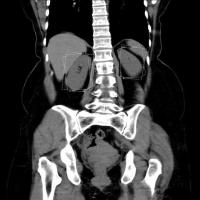 Kidney project thumbnail