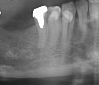 Jaw_degradation project thumbnail