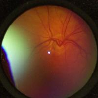 Fundus Detection project thumbnail