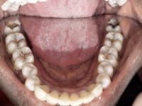 new1 mandibular project thumbnail