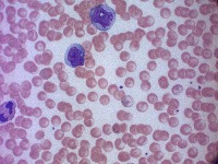 Malaria detection project thumbnail