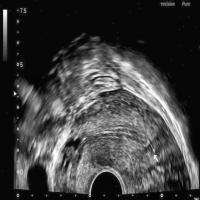 endometrial receptivity project thumbnail