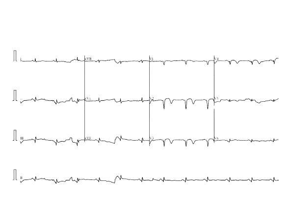6 ECG heart classification class Object Detection Dataset by Roboflow5