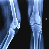 BONE FRACTURE  project thumbnail