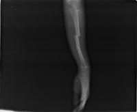 Bone Fracture Detection project thumbnail