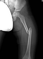 Bone Fracture Detection (100) project thumbnail