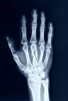 Bone Fracture Detection 60 project thumbnail