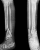 Bone Fracture Detection 80 project thumbnail