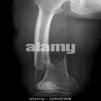 Bone Fracture Detection (10) project thumbnail