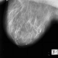 breast cancer project thumbnail