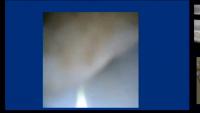 Kidney-Stone project thumbnail