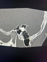 2nd genu angle detection project thumbnail