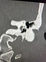 facial nerve postion ant or post project thumbnail