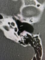facial recess opacity detection project thumbnail