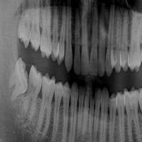 Wisdom_Teeth_Detection project thumbnail