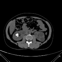 Kidney_pridction project thumbnail