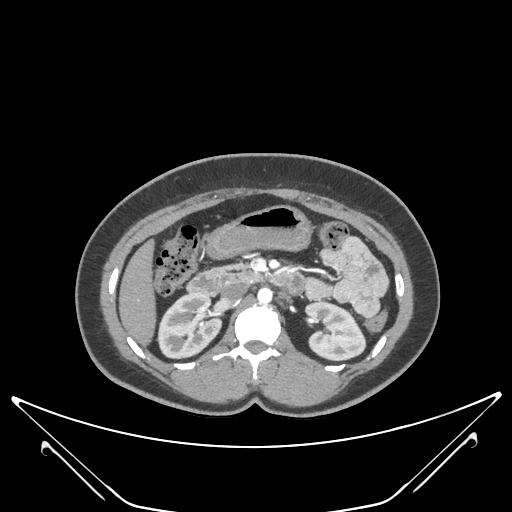 Deteksi Tumor Ginjal Object Detection Dataset and Pre-Trained Model by ...