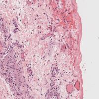 Colostomy closure  project thumbnail