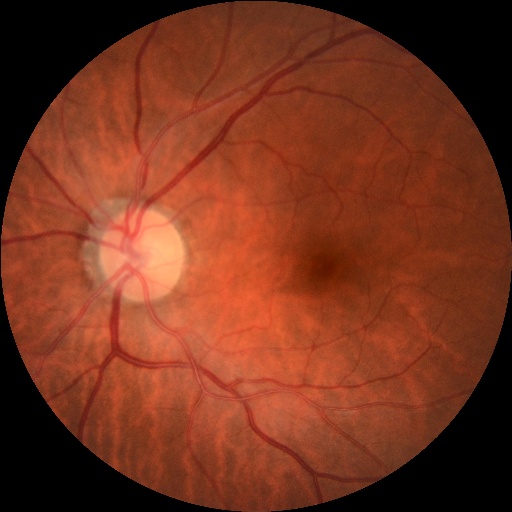 How to Use the Retinal Disease detection Object Detection API