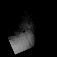 Spondlylolisthesis project thumbnail