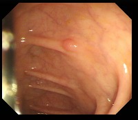 Polyp Detection in Colonoscopy Images Object Detection Model by Polyp