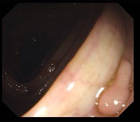 Polyp Detection in Colonoscopy Images Object Detection Model by Polyp